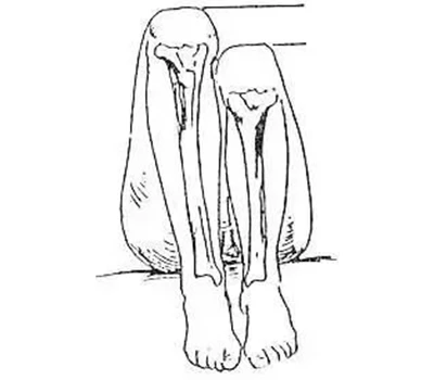 Évaluation des écarts de longueur des jambes (LLD) : un guide pratique pour les applications liée...
