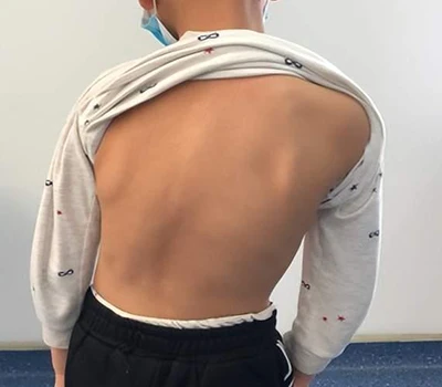Dépistage et prise en charge de la scoliose : comment le scanner corporel 3D Xianku aide les chir...