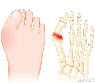 Hallux Valgus : un guide scientifique complet