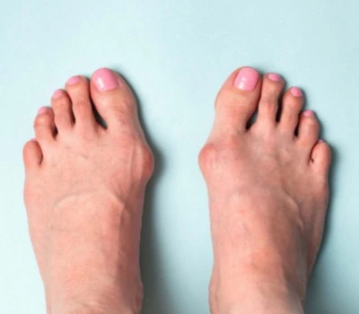 L'épidémie silencieuse : les problèmes de pieds chez les enfants sont plus courants que vous ne l...