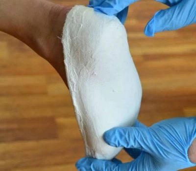 Comment les scanners de pieds 3D transformeront-ils l’avenir des appareils de support orthopédique ?
