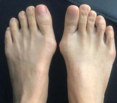 La mesure de Hallux Valgus: pourquoi les scanners 3D dépassent les cliniciens et les hôpitaux