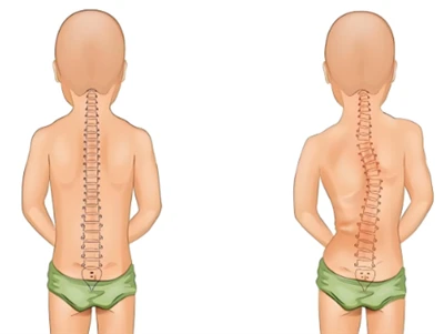 Nouvelle méthode de dépistage de la scoliose : colonne vertébrale numérique IA et 3D