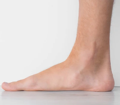 L'épidémie silencieuse : comprendre les pieds plats et les solutions technologiques pour relever ...