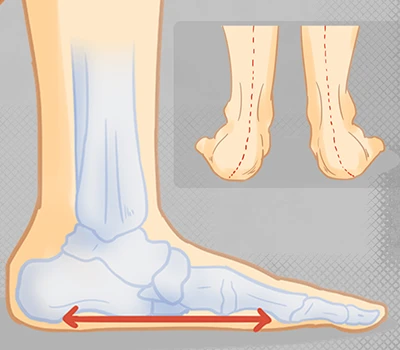 Pieds plats : le problème de santé silencieux qui touche des millions de personnes et comment la ...